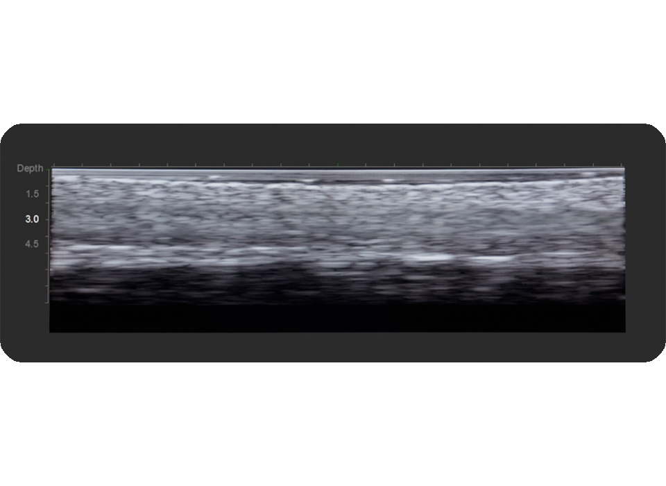 Thermage FLX
